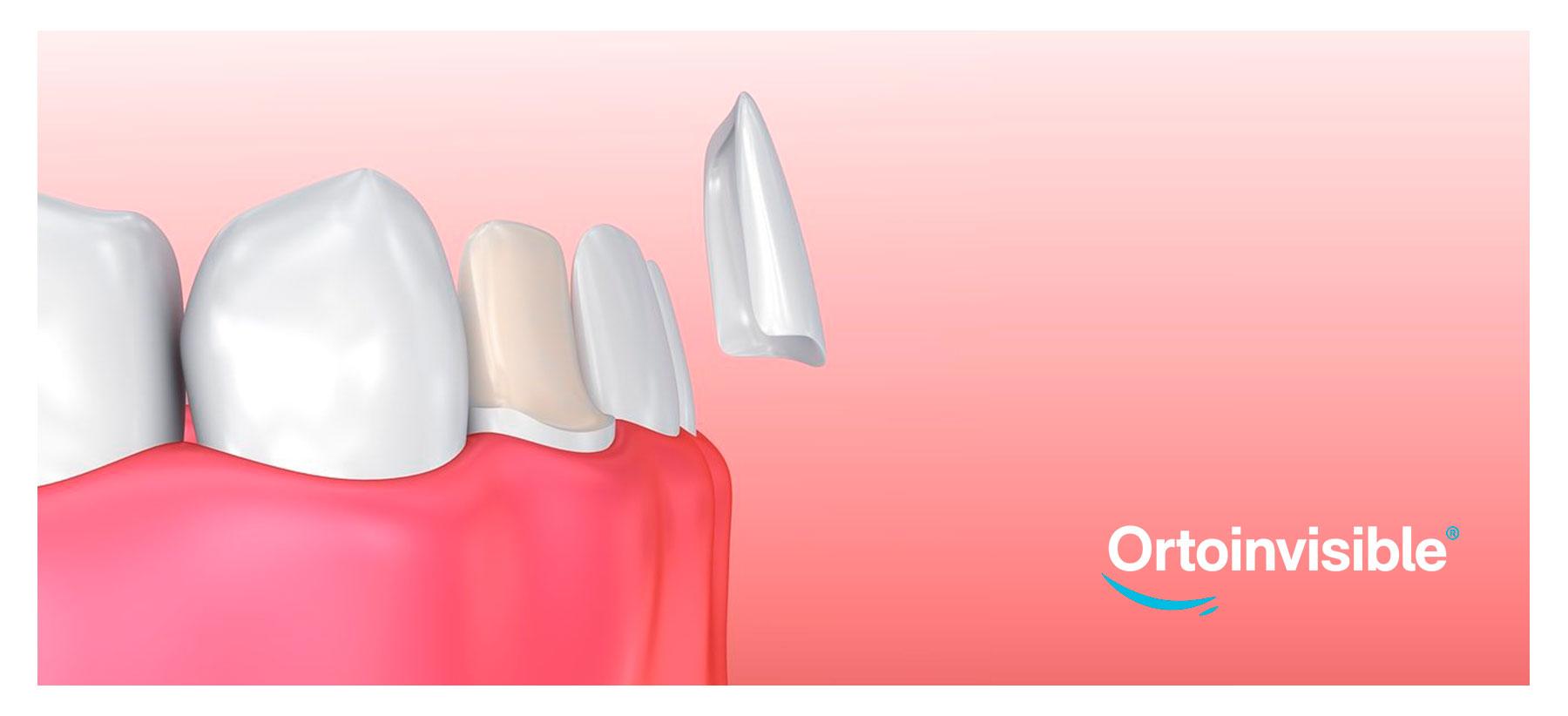 Tipos de carillas dentales y sus diferencias