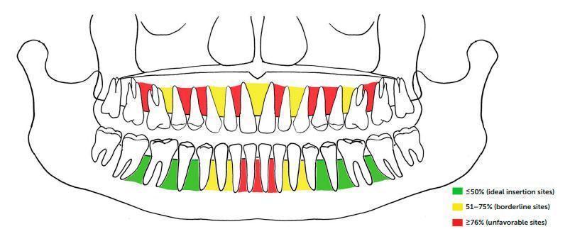 Donde se colocan los microtornillos en ortodoncia